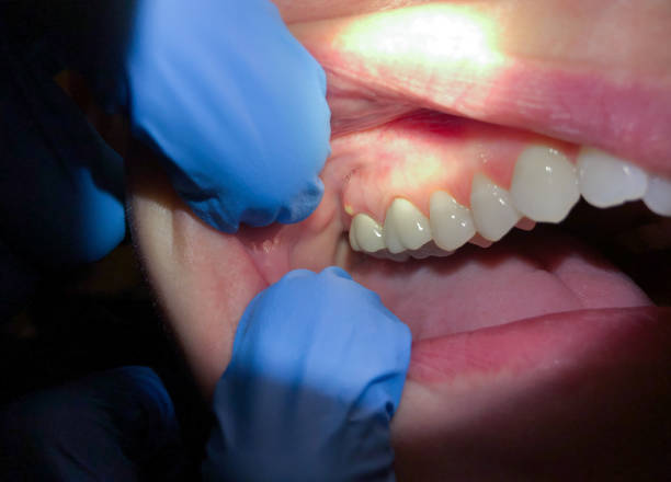 Best Emergency Root Canal Treatment in Moravian Falls, NC
